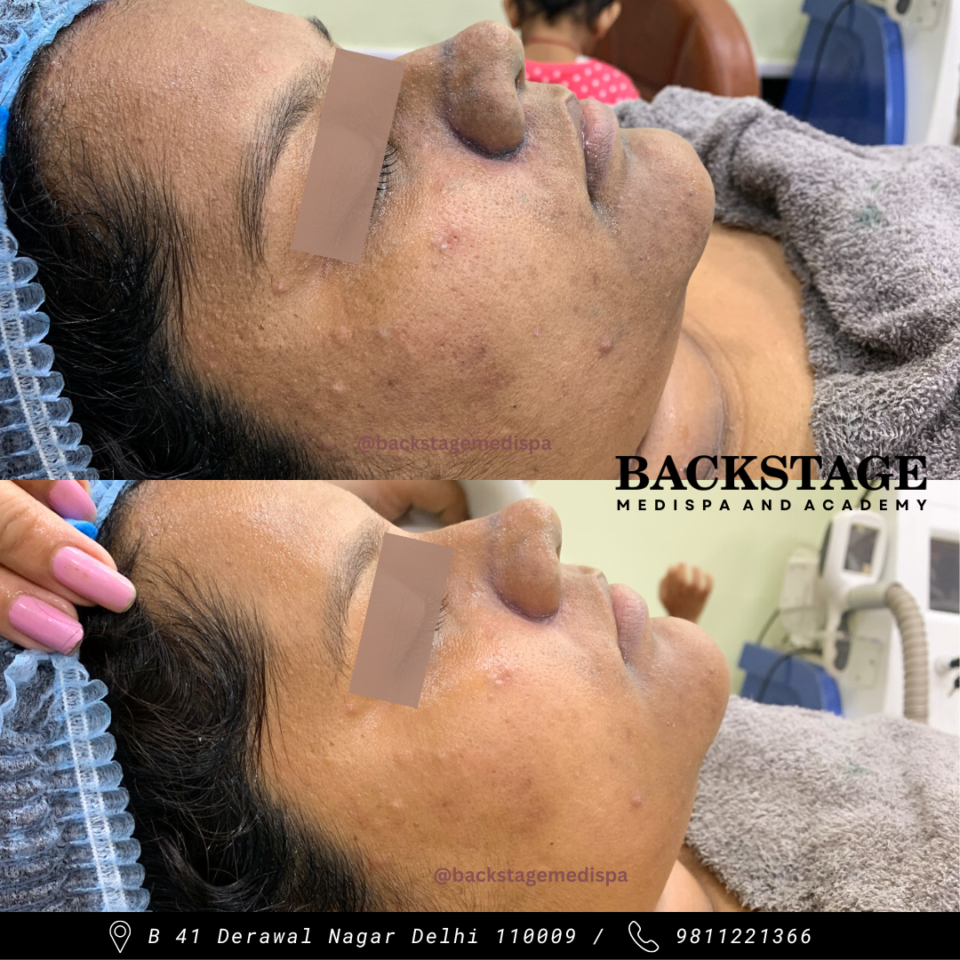 Hyperpigmentation Treatment In Delhi Backstage Delhi