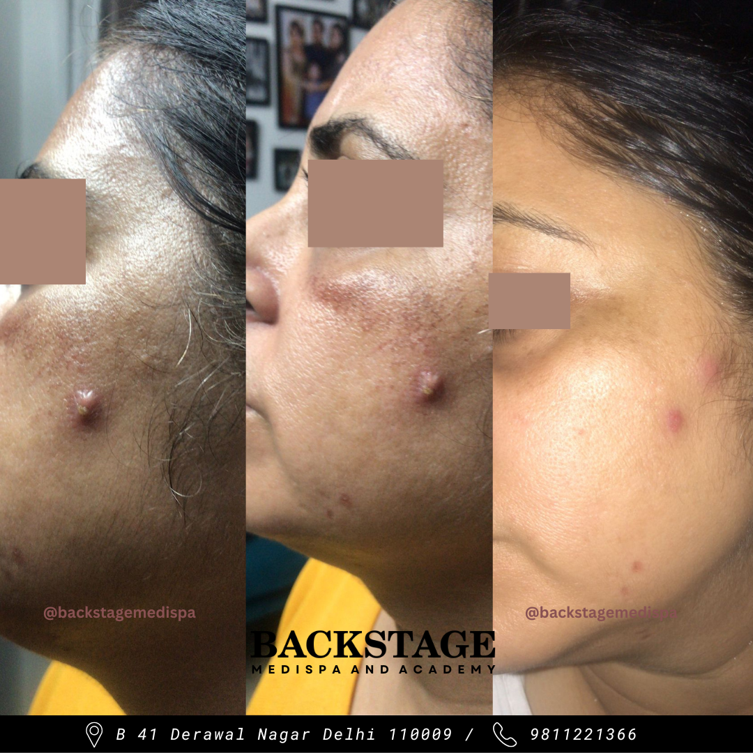 HYPERPIGMENTATION TREATMENT IN DELHI Backstage Delhi