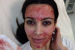 vampire facial prp kim kardashian