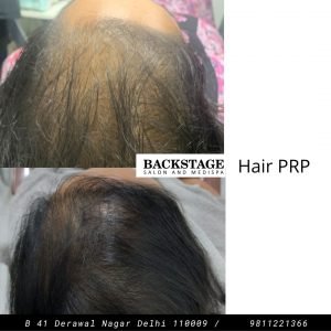 prp before after hair loss treatment hair growth