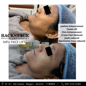 hifu non surgical face lift results before after 2