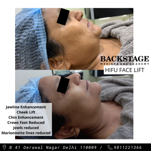 hifu non surgical face lift results before after 1