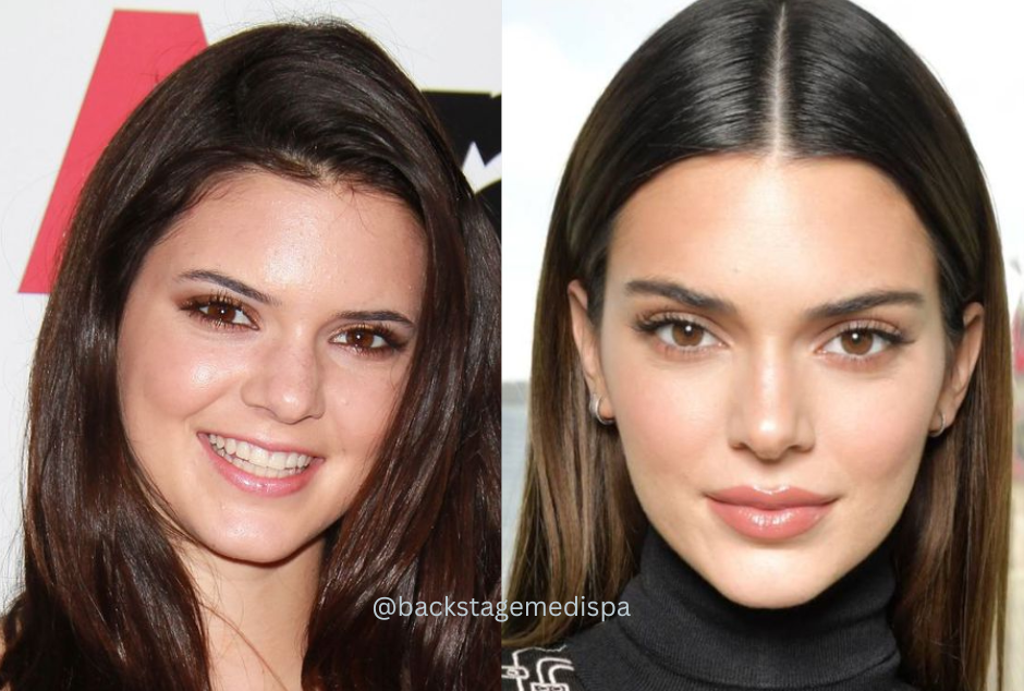 kendall jenner lip fillers augmentations backstage medispa delhi