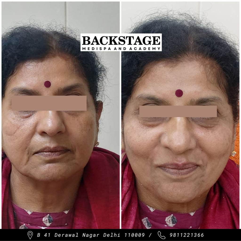 anti aging wrinkle treatment results before after model town delhi