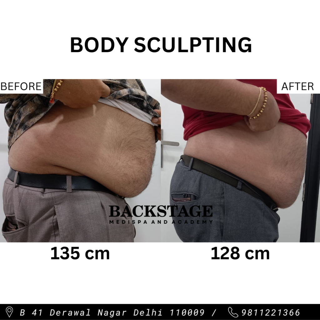body sculpting fat loss hifem emsculpt backstage delhi model town